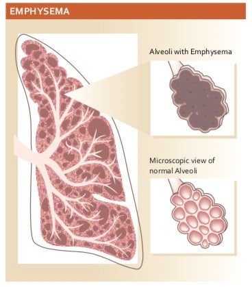 COPD,